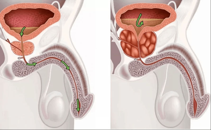 Prostatite symptoms